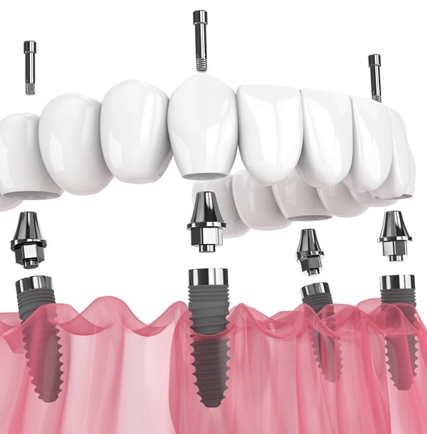 all-on-4-dental-implants-in-lynn-valley-dental-centre