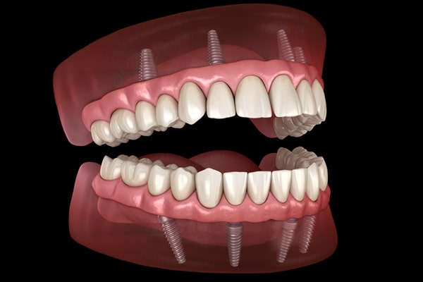all-on-4-dental-implants-lynn-valley-dental-centre