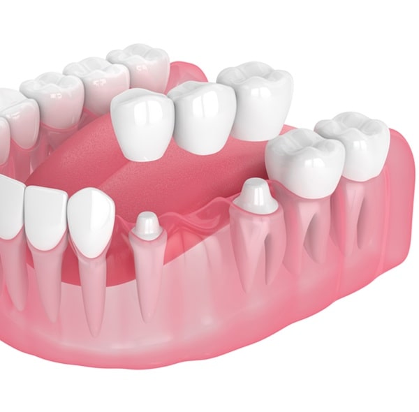 dental-bridges-in-lynn-valley-dental-centre