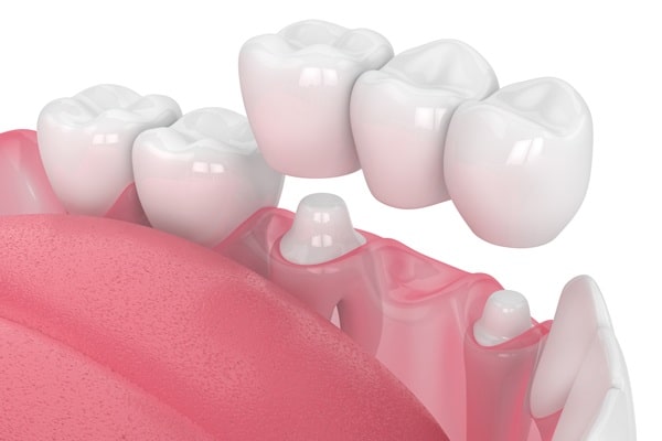 dental-bridges-lynn-valley-dental-centre