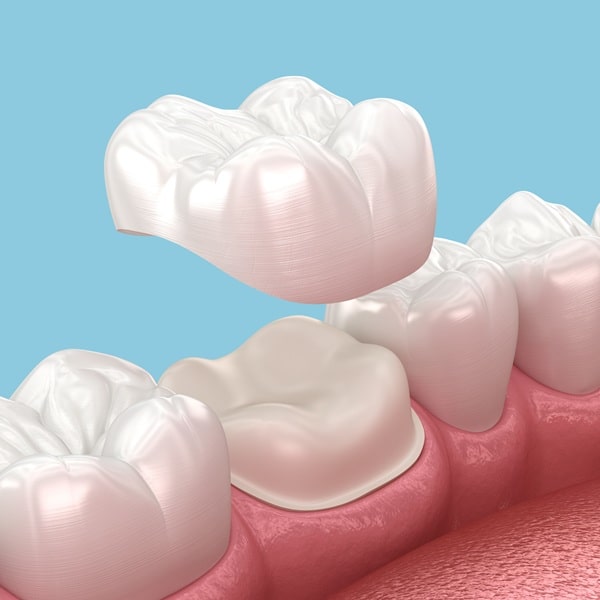 dental-crowns-in-lynn-valley-dental-centre