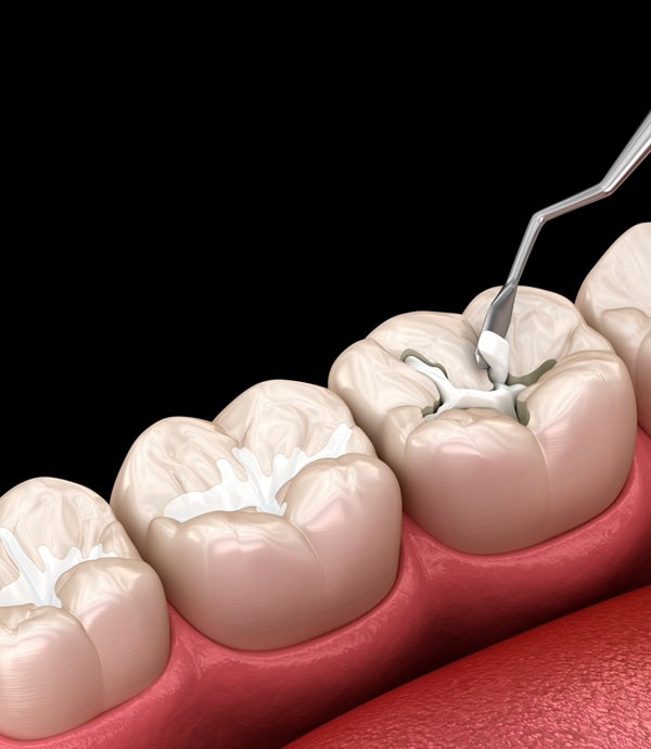 dental-fillings-in-lynn-valley-dental-centre