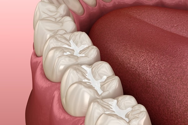 dental-fillings-lynn-valley-dental-centre