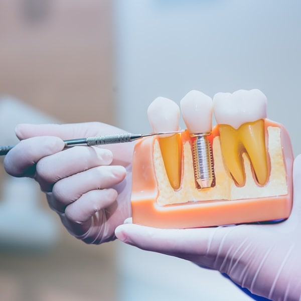 dental-implants-in-lynn-valley-dental-centre