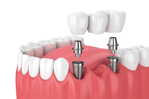 dental-implants-lynn-valley-dental-centre