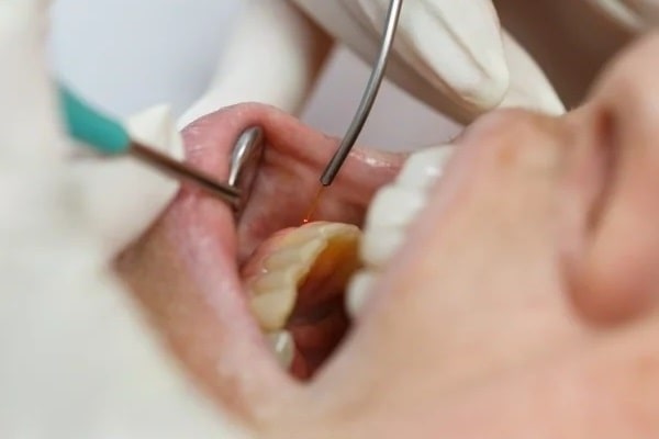 dental-lasers-in-lynn-valley-dental-centre