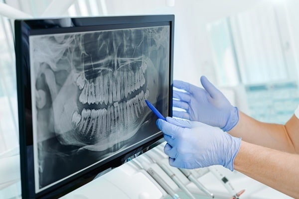 dental-x-rays-lynn-valley-dental-centre