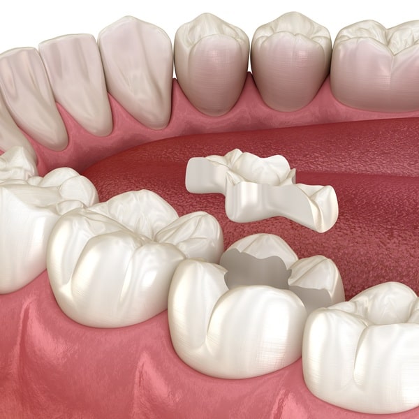 inlays-and-onlays-in-lynn-valley-dental-centre