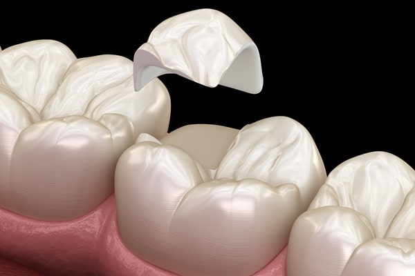 inlays-and-onlays-lynn-valley-dental-centre