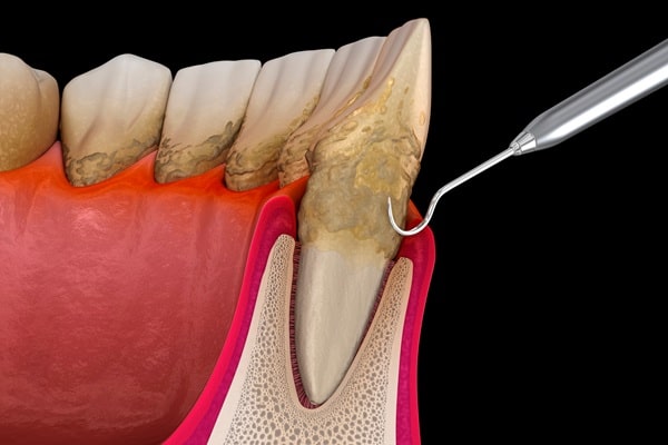 periodontics-lynn-valley-dental-centre