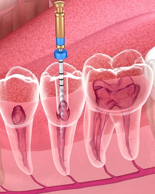 root-canals-in-lynn-valley-dental