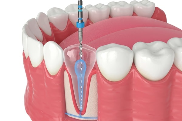 root-canals-lynn-valley-dental-centre