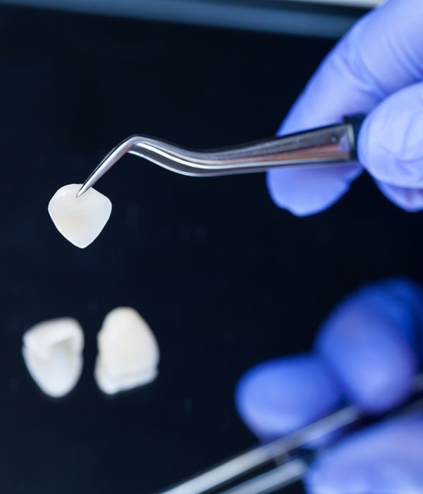 veneers-in-lynn-valley-dental-centre